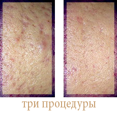 исправление за три процедуры исправление рубцов