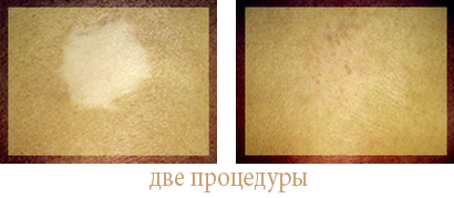 исправление за две процедуры исправление рубцов